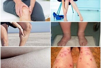 腿上静脉曲张的症状