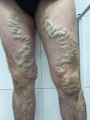 被忽视的男性静脉曲张