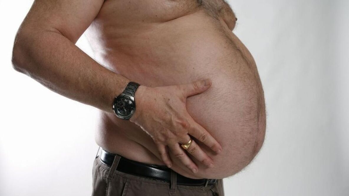 肥胖是静脉曲张发展的一个原因