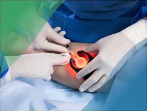 硬化疗法是一种微创技术，用于治疗下肢静脉曲张。